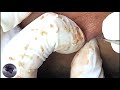 asmr blackheads extractions with cse my business 107