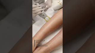 Laser Hair Removal In Dubai | Candela GentleMax Pro