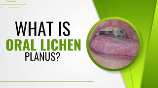 What is Oral Lichen Planus? | Top Possible Causes