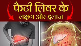 फैटी लिवर के लक्षण और इलाज  | Causes and Treatment of Fatty Liver | Bharat Homeopathy