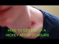 how to get rid of a hickey after 24 hours