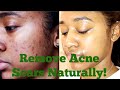 How to: Remove My Acne Scars Naturally| Essential Oils, Derma Roller + More! How to: Remove My Acne Scars Naturally| Essential Oils, Derma Roller + More!