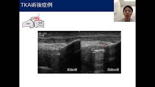 膝関節の可動域制限に対する膝蓋下脂肪体の影響