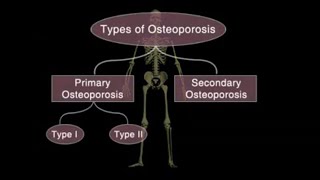 Osteoporosis: 3D medical animation