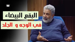 الشعور المسبب للبقع البيضاء، البرص، البهاق، الصدفية،  الاكزيما و تصبغات الجلد و شيب الشعر