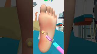 Remove worms in the soles of the feet#shorts