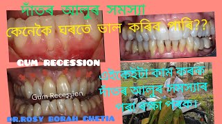 Gum recession/দাঁতৰ আলুৰ সমস্যা ঘৰতে কেনেকৈ ঠিক কৰিব পাৰি?