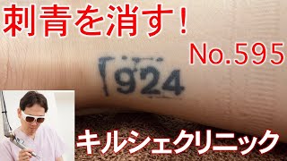 【ピコレーザー】レーザーによるタトゥー除去595【エンライトン】