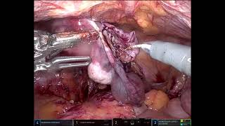 Unedited video of Robotic assisted hyst + lymph node dissection for an early endometrial cancer