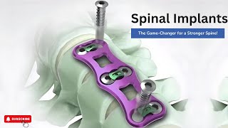 Spinal Implants: The Game-Changer for a Stronger Spine!  #health #doctor #drajaykothari