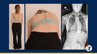 Blood Loss in Scoliosis Surgery