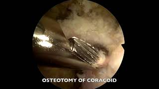 All Arthroscopic Trillat Procedure Using Screw Fixation for Recurrent Shoulder Instability