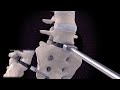 spine innovations lp esp surgical technique