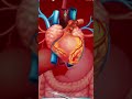 How Does Heart Bypass Surgery Work Coronary Artery Bypass Graft Procedure Animation CABG Video