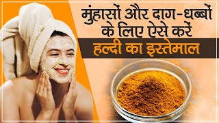 Turmeric For Acne: मुंहासों और दाग-धब्बों के लिए ऐसे करें हल्दी का इस्तेमाल