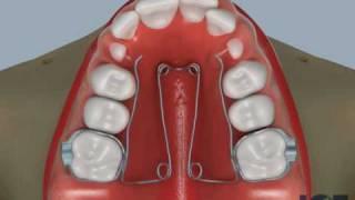Quad Helix Appliance Part 2