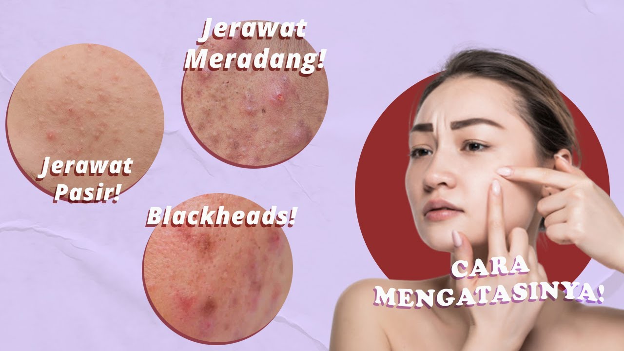 6 Jenis Jerawat Yang Sering Muncul Dan Cara Mengatasinya! - YouTube