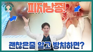 피지낭종 괜찮은줄 알고 방치하면?  【건대성모외과의원】