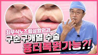 구순구개열 수술 흉터 복원 가능할까?