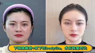 下颌角截骨+双下巴bodytite（骨相+皮相）双减法，改脸型术后40天恢复对比