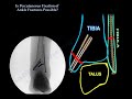 ankle fractures minimally invasive fixation everything you need to know dr. nabil ebraheim