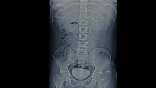 KUB X ray Show Kidney Stone #aiims #shortsvideo #biology #doctor #mbbs