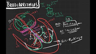 ECG: BRADIARRITMIAS - Disfunción del Nodo Sinusal (S.S.S) - PARTE 1