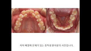 삐뚤삐뚤한 치아를 가지런하게 교정 치료 해 봅시다