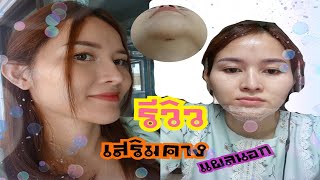 รีวิวเสริมคางแผลนอก ครั้งแรกในชีวิต เล่าจากประสบการณ์จริง