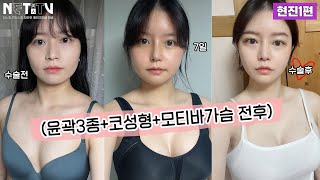 쫄보지만 큰맘먹고 윤곽수술, 가슴수술, 코성형까지 한번에 싹~☺ 얼굴 소멸 직전까지 예쁘게 깎았어요! 붓기도 거의없고 체질인가봐~🥰