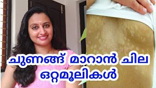 ചുണങ്ങിനെ മാറ്റാൻ എളുപ്പവഴികൾ /chunangu maran/ചുണങ്ങ് മാറാൻ/melasma treatment at home