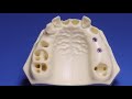 straumann® blx implant system healed sites