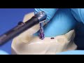 Straumann® BLX Implant System - Healed Sites