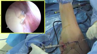 Arthroscopic SLAP repair by Dr. Patrick Jost