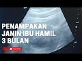 Penampakan Hasil USG janin ibu hamil 3 bulan