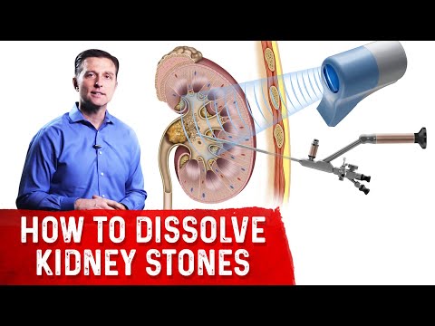 How to Dissolve Kidney Stones (Part 1) How to Dissolve Kidney Stones (Part 1)