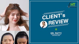 คุณแยม : รีวิวผลลัพธ์ ll ปลูกผมถาวรปรับกรอบหน้าที่ Hairtran Clinic