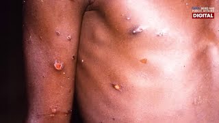 Ano-ano ang mga sintomas ng monkeypox? | Need To Know