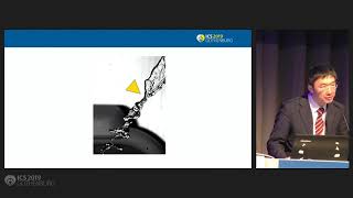 #526 OBSERVATION OF VORTICITY IN EVACUATED URINE STREAM FROM MALE URETHRA USING HIGH SPEED VIDEO CAM