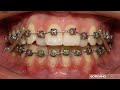 উঁচু দাঁত নিচু করার চিকিৎসা fixed braces treatment in bangla by smile bd.