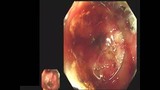 PEG fistula closure with OVESCO clip system