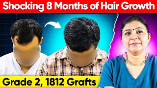 Hair Transplant Results (1812 Grafts, Grade 2) by Dr Preeti Saraswat: Saraswat Hospital, Agra, India