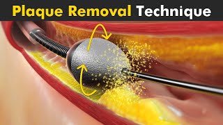 How Atherectomy is Performed? | Removal Of Plaque From Arteries