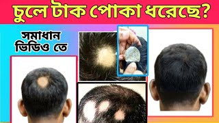 টাক পোকা থেকে মুক্তি পাওয়ার উপায় | How to treatment alopecia areata | Hair system | Hair Style Int