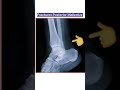 Ankle Fracture's | X-ray Ankle Joint | Fracture Medial Lateral & Posterior Malleolus #shorts #xray