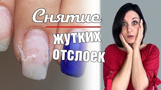 Жуткие отслойки, как делать снятие отслоек.