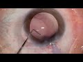 phaco clip 67 young lamellar cataract