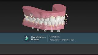 Aligners designing #midline and canine corrections severe crowding