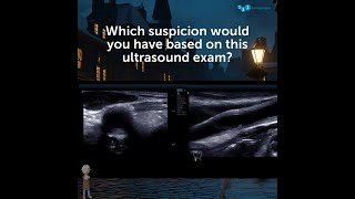 Ultrasound Detective: Which suspicion would you have based on this carotid ultrasound exam?