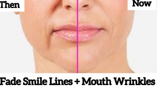 Remove Smile Lines and Lift Mouth Corners - Reduce Nasolabial Folds and Droopy Mouth Corners